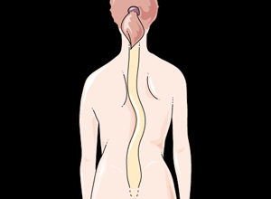 Disability Interview with Kathleen Kathleen Disability Interview: Scoliosis example